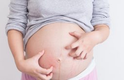 Nổi mề đay khi mang thai là gì?