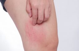 Nổi mề đay có kiêng gió không?