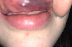 Dị ứng mỹ phẩm có thể khiến bạn bị nổi mề đay sưng môi