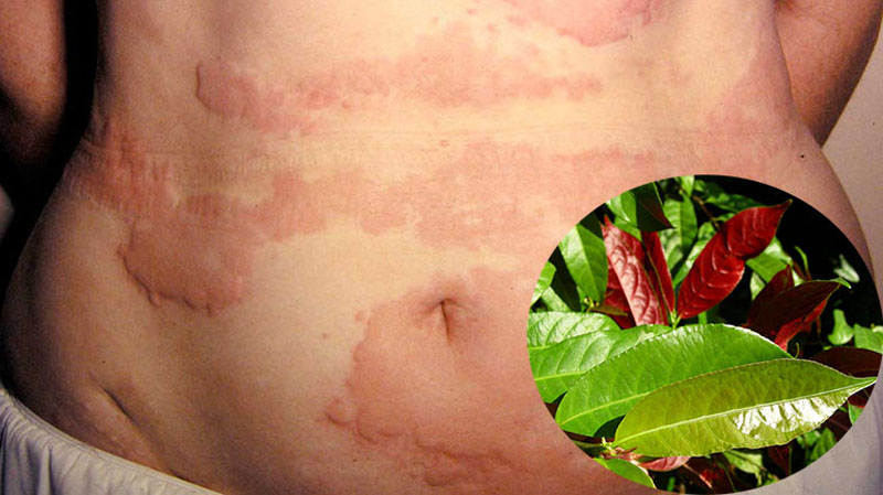 Cơn ngứa ngáy sẽ giảm thiểu ngay nhờ bài thuốc từ lá đơn đỏ Cơn ngứa ngáy sẽ giảm thiểu ngay nhờ bài thuốc từ lá đơn đỏ