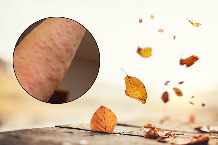 Nổi mề đay có kiêng gió không? có nằm quạt được không? nổi mề đay có kiêng gió không