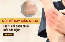 Cách chữa nổi mề đay Đỗ Minh Đường