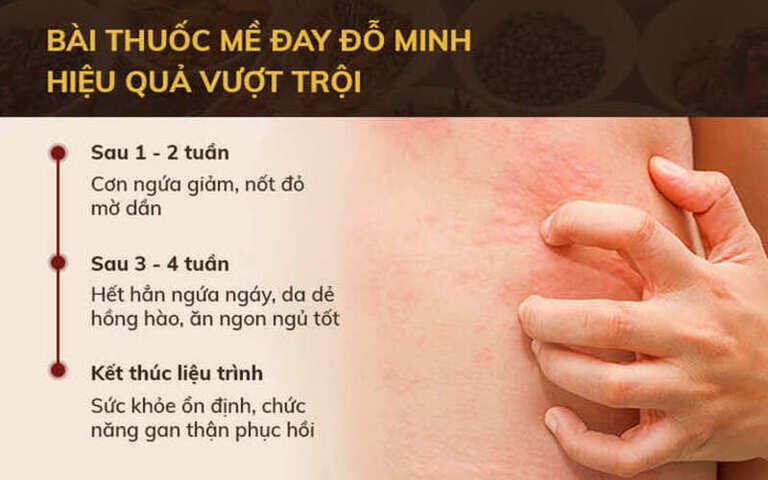 Hiệu quả bài thuốc Mề đay Đỗ Minh theo từng giai đoạn điều trị Hiệu quả bài thuốc Mề đay Đỗ Minh theo từng giai đoạn điều trị