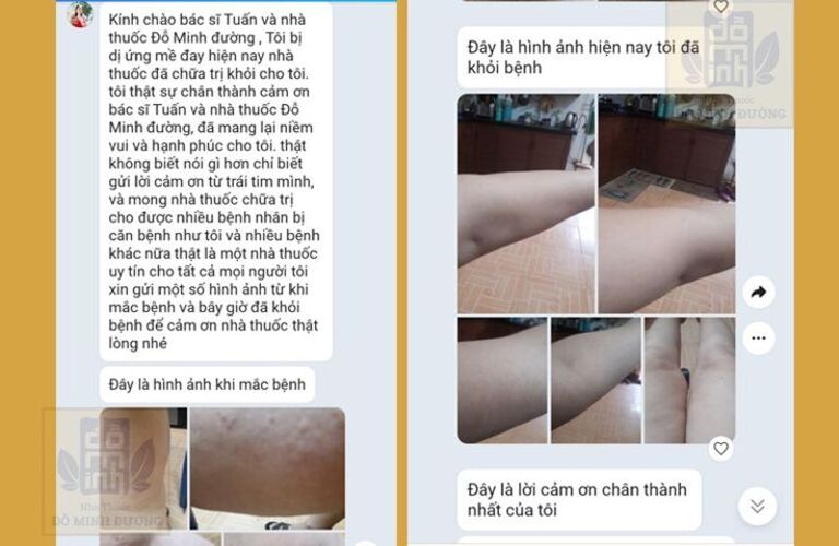 Người bệnh phản hồi rất tích cực về hiệu quả bài thuốc Mề đay Đỗ Minh Người bệnh phản hồi rất tích cực về hiệu quả bài thuốc Mề đay Đỗ Minh