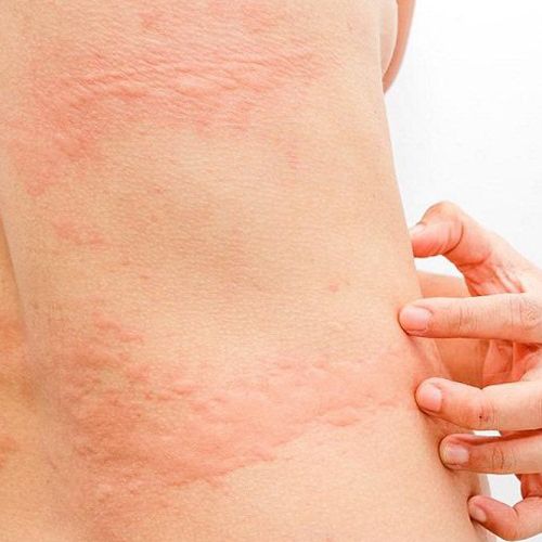 Mề đay là bệnh da liễu ngày càng phổ biến nhưng không phải ai cũng biết cách chữa trị Mề đay là bệnh da liễu ngày càng phổ biến nhưng không phải ai cũng biết cách chữa trị